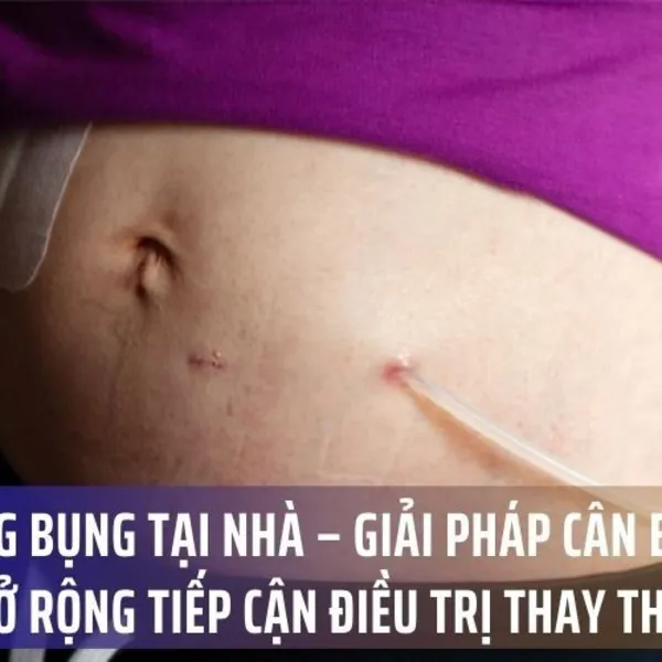 Lọc màng bụng tại nhà–Giải pháp cân bằng nhằm mở rộng tiếp cận điều trị thay thế thận