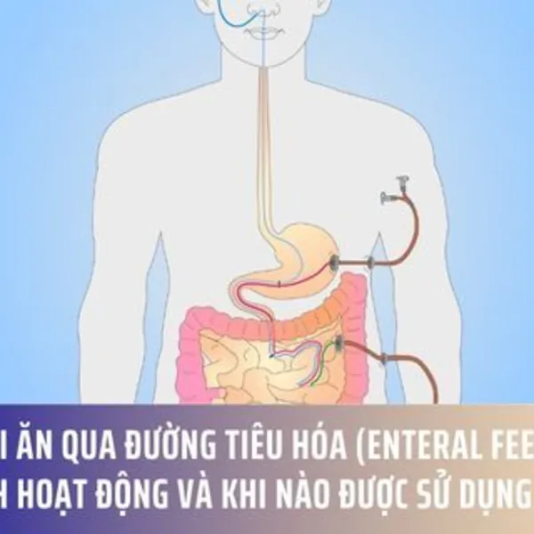 Nuôi ăn qua đường tiêu hóa (Enteral Feeding): Cách hoạt động và khi nào được sử dụng