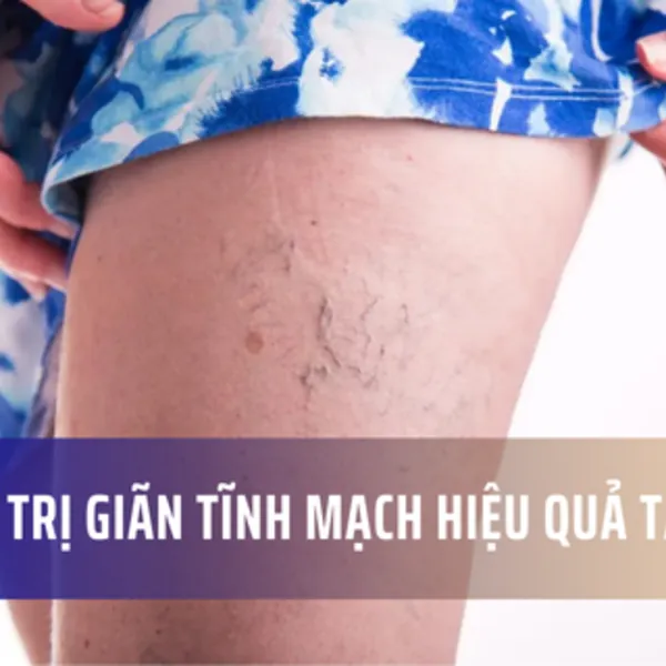 10 Cách điều trị bệnh giãn tĩnh mạch đơn giản hiệu quả tại nhà