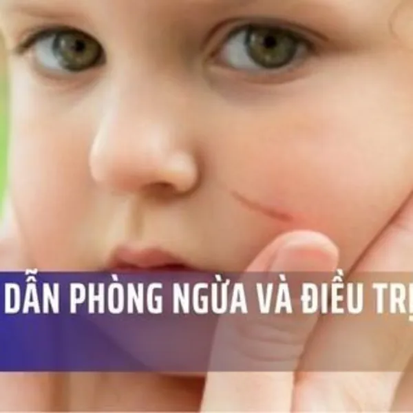 Hướng dẫn phòng ngừa và điều trị sẹo ở trẻ em