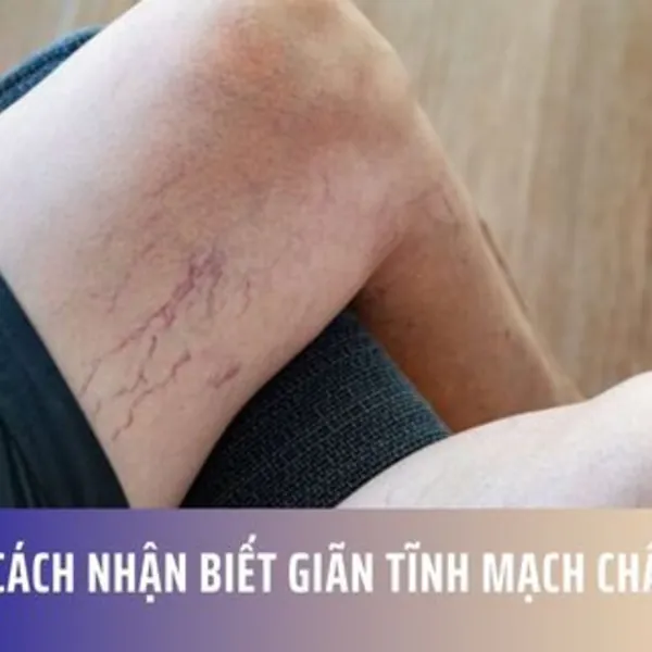 Cách nhận biết giãn tĩnh mạch chân