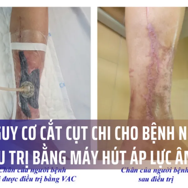Giảm nguy cơ cắt cụt chi cho bệnh nhân nhờ điều trị bằng máy hút áp lực âm