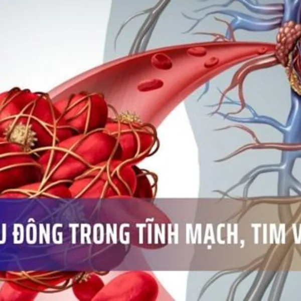Cục máu đông trong tĩnh mạch, tim và phổi