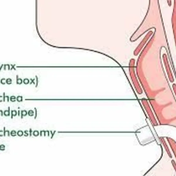 Các cách để đạt được giọng nói bằng phẫu thuật mở khí quản