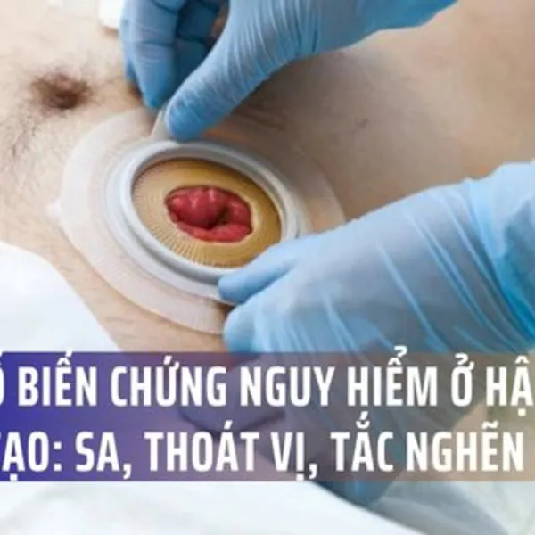 Biến chứng thường gặp ở hậu môn nhân tạo: Sa, thoát vị, tắc nghẽn