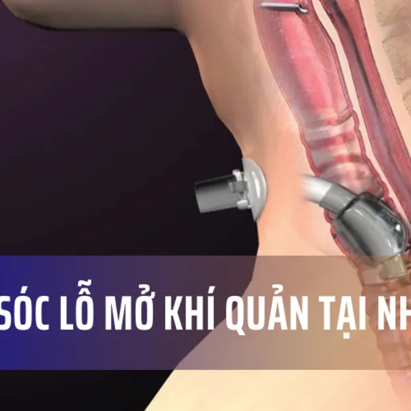 Chăm sóc lỗ mở khí quản tại nhà