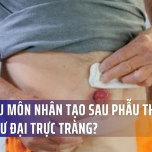 Mở hậu môn nhân tạo sau phẫu thuật ung thư đại trực tràng?