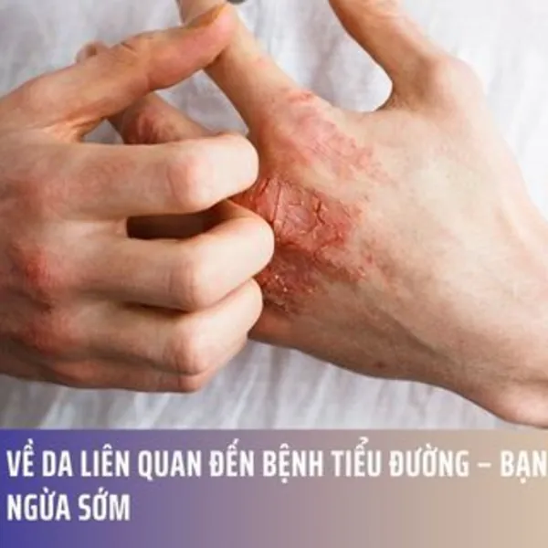 10 Vấn Đề Về Da Liên Quan Đến Bệnh Tiểu Đường – Bạn Cần Biết Để Phòng Ngừa Sớm