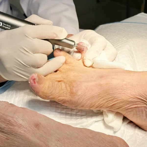 Cách chăm sóc móng chân cho người tiểu đường