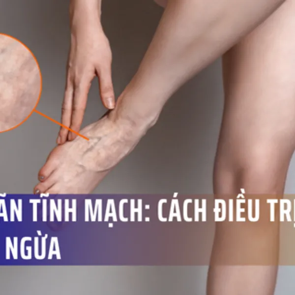 Suy giãn tĩnh mạch là gì? Chẩn đoán, chữa trị và phòng tránh suy giãn tĩnh mạch