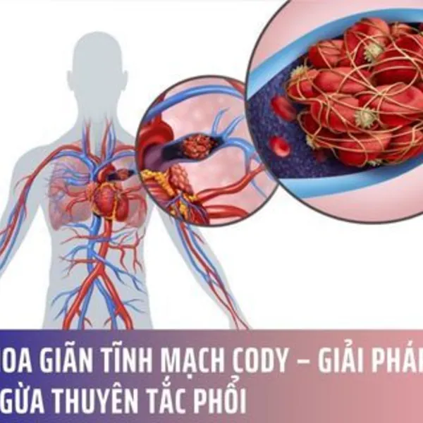 Vớ Y Khoa Giãn Tĩnh Mạch Cody – Giải Pháp Hỗ Trợ Ngăn Ngừa Thuyên Tắc Phổi