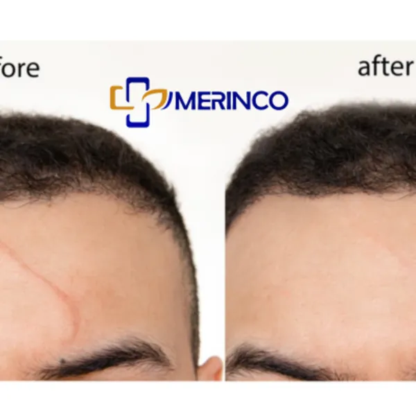 Gel bôi sẹo có dùng sau phẫu thuật thẩm mỹ được không?