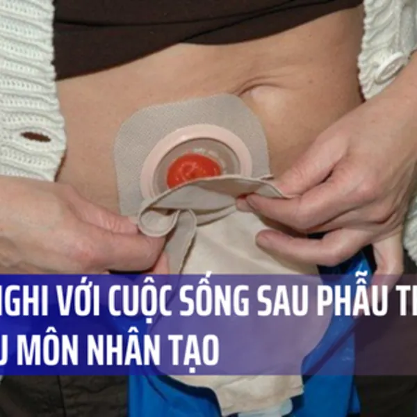 Thích nghi với cuộc sống sau phẫu thuật mở hậu môn nhân tạo (P1)