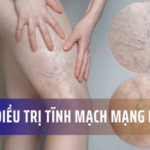 Tĩnh mạch mạng nhện là gì? Các cách điều trị tĩnh mạch mạng nhện