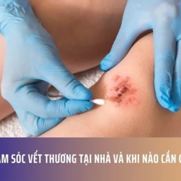 Cách Chăm Sóc Vết Thương Tại Nhà và Khi Nào Cần Gặp Bác Sĩ