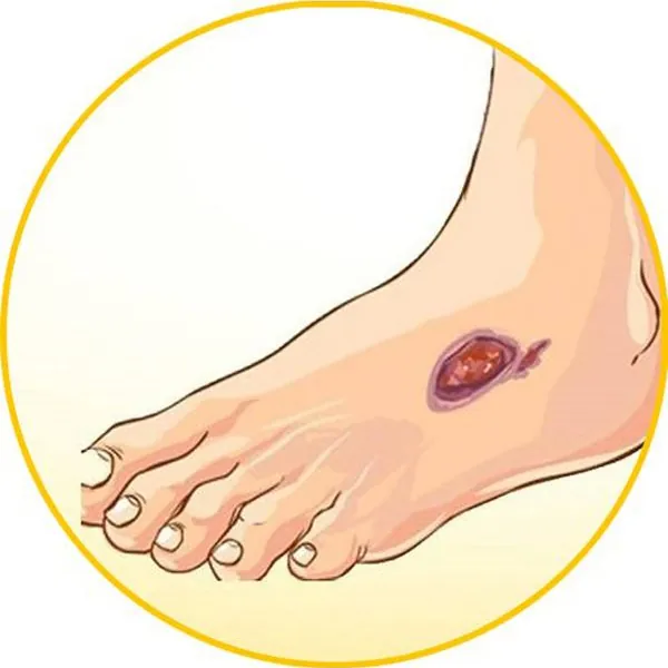 Chăm sóc loét tì đè theo từng giai đoạn bệnh