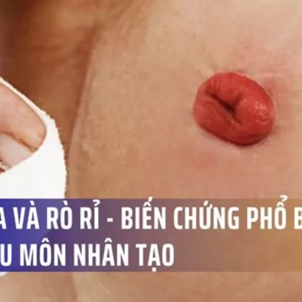 Biến chứng phổ biến của hậu môn nhân tạo: Vấn đề về da và rò rỉ