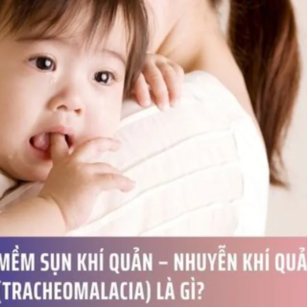Mềm sụn khí quản – nhuyễn khí quản (Tracheomalacia) là gì?