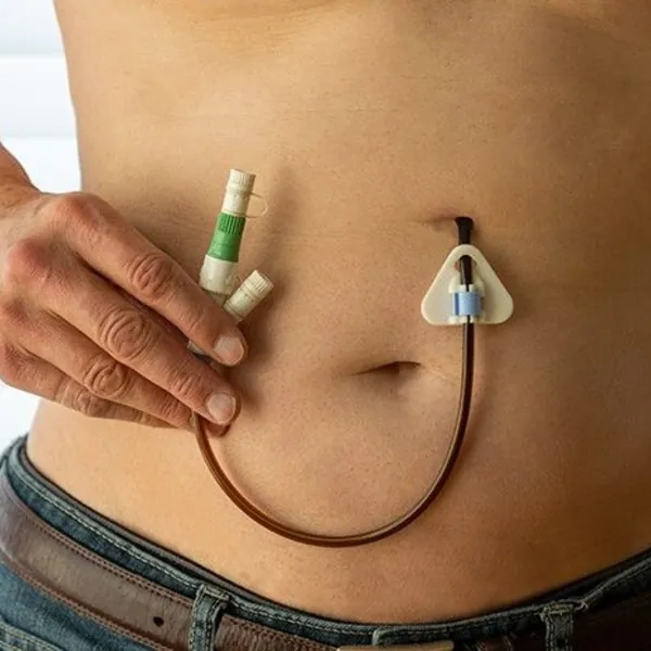 Cách nhận biết, phòng ngừa và khắc phục khi ống nuôi ăn đường ruột bị tuột