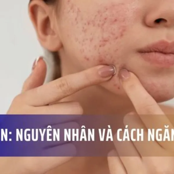Nguyên nhân gây ra sẹo mụn và cách ngăn ngừa