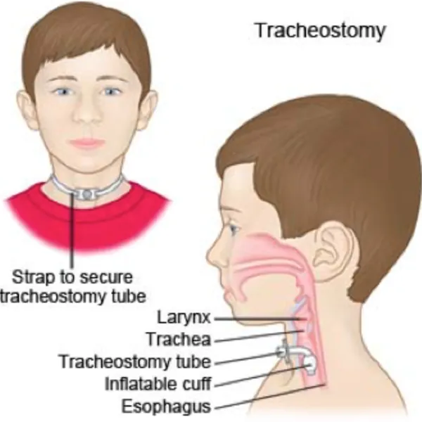 Thời điểm mở khí quản ở trẻ em