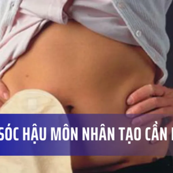 Những lưu ý khi chăm sóc hậu môn nhân tạo