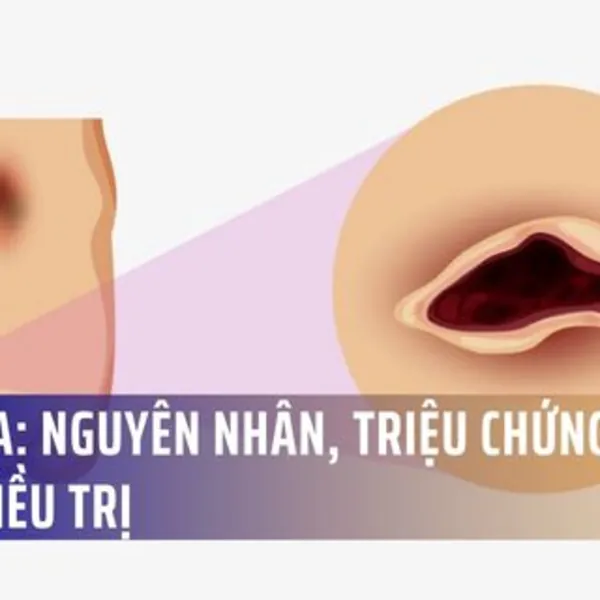 Loét da: nguyên nhân, triệu chứng và cách điều trị