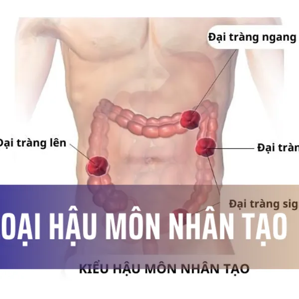 Cẩm nang hướng dẫn chăm sóc hậu môn nhân tạo cho điều dưỡng và y tá (Phần 1)