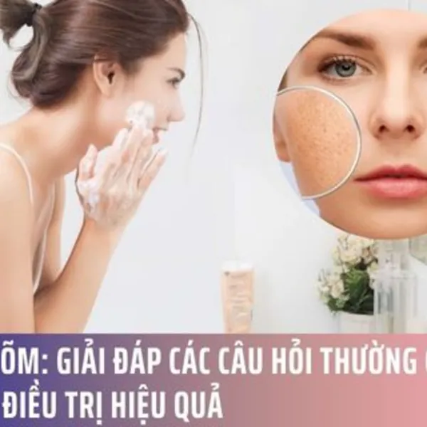 Sẹo Lõm: Giải Đáp Các Câu Hỏi Thường Gặp & Cách Điều Trị Hiệu Quả