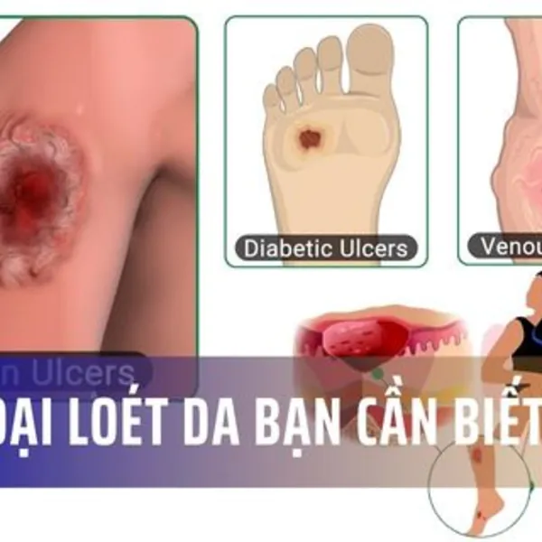 Tìm hiểu các loại loét da