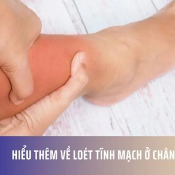 Hiểu Thêm Về Loét Tĩnh Mạch ở Chân
