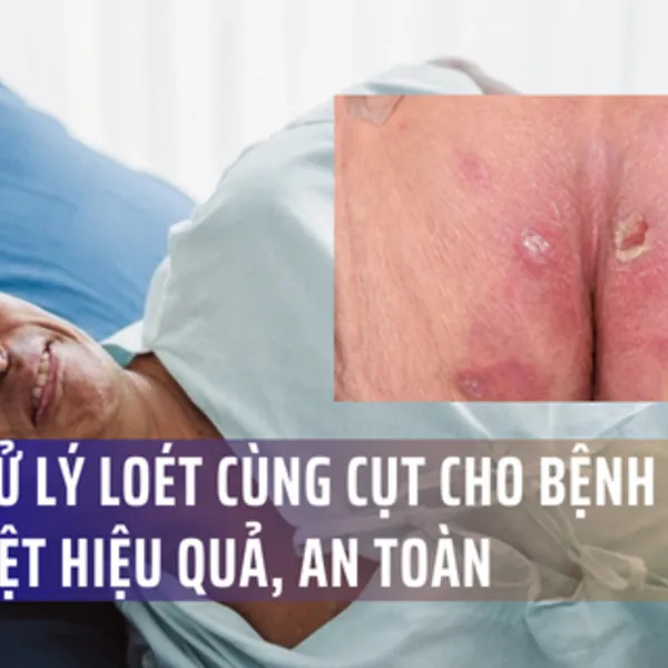 Xử lý loét cùng cụt cho người nằm liệt nhanh chóng, đơn giản không phải ai cũng biết!