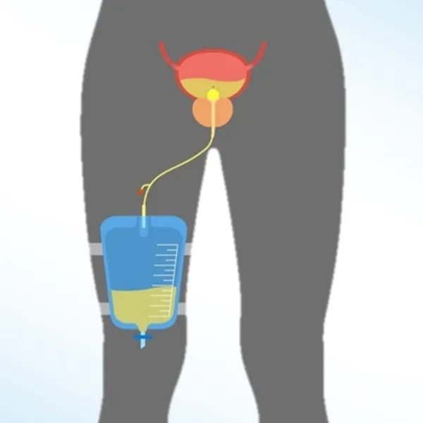 Lời khuyên khi sử dụng ống thông tiểu tại nhà