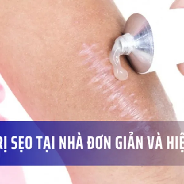 Bật mí cách trị sẹo lồi tại nhà đơn giản, an toàn, hiệu quả
