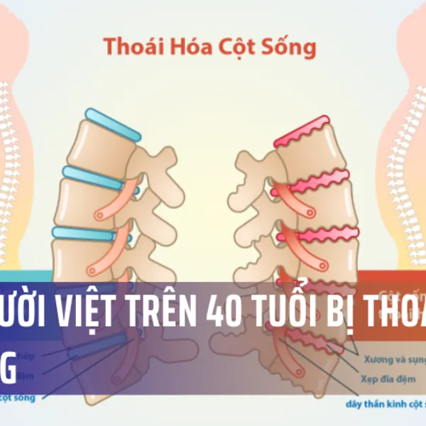 60% người Việt trên 40 tuổi bị thoái hoá cột sống, căn bệnh có thể gây ra bại liệt, tàn phế