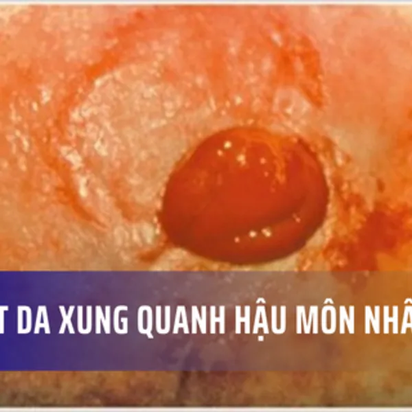 Cách trị loét da xung quanh hậu môn nhân tạo