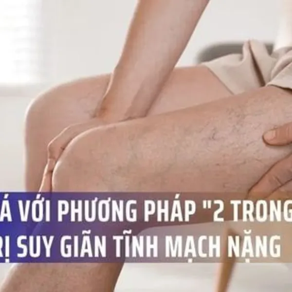 Đột phá với phương pháp "2 trong 1" điều trị suy giãn tĩnh mạch nặng