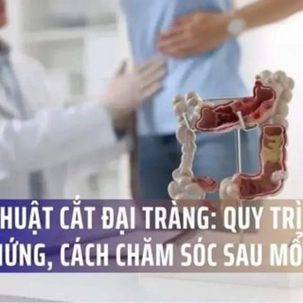 Phẫu Thuật Cắt Đại Tràng: Quy Trình, Biến Chứng Và Cách Chăm Sóc Sau Mổ
