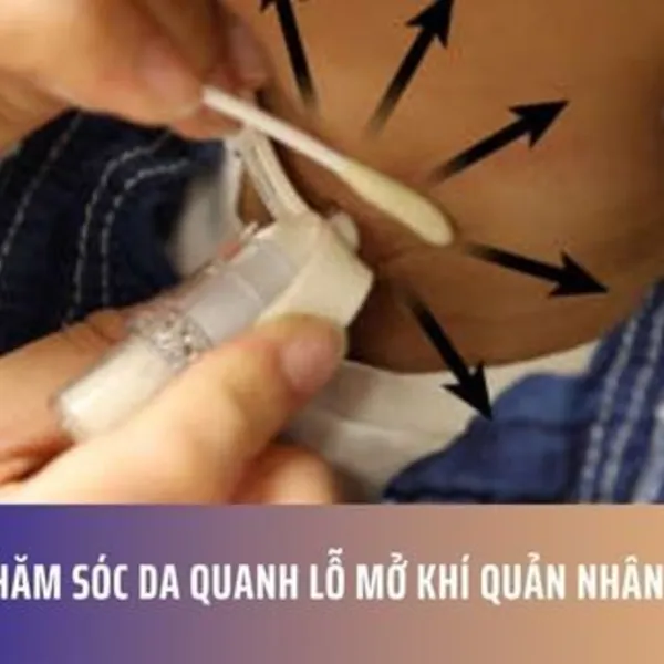 Chăm Sóc Da Quanh Lỗ Mở Khí Quản Nhân Tạo