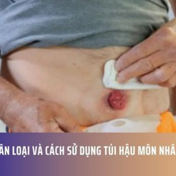 Phân loại và cách sử dụng túi hậu môn nhân tạo