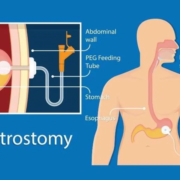 Chăm sóc bệnh nhân có ống nuôi ăn đường ruột