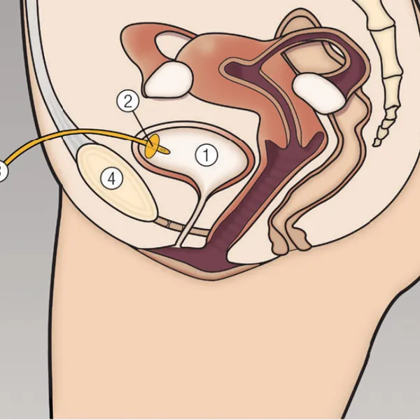 Tìm hiểu về dẫn lưu bàng quang trên xương mu: Thời gian lưu ống, cách chăm sóc, và lưu ý (Phần 2)