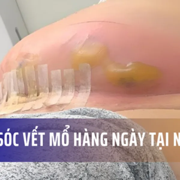 Cách chăm sóc vết mổ hàng ngày tại nhà