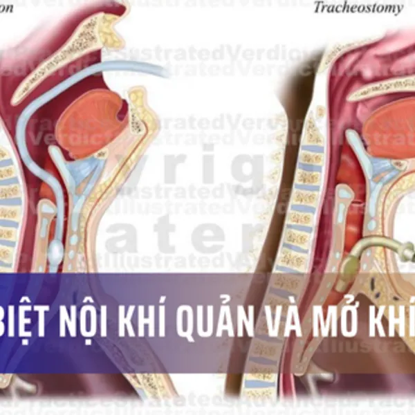 Phân biệt giữa đặt nội khí quản và mở khí quản: Bạn đã biết chưa?