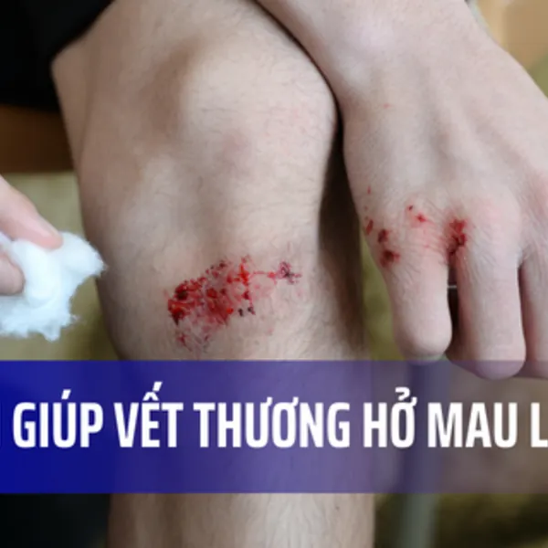 6 phương pháp giúp vết thương hở mau lành hơn