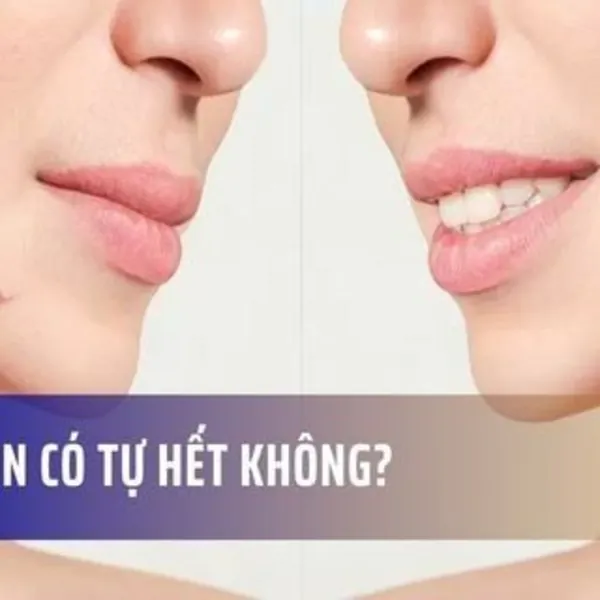 Sẹo mụn có tự hết không?
