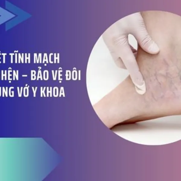 Tạm Biệt Tĩnh Mạch Mạng Nhện – Bảo Vệ Đôi Chân Cùng Vớ Y Khoa Cody!