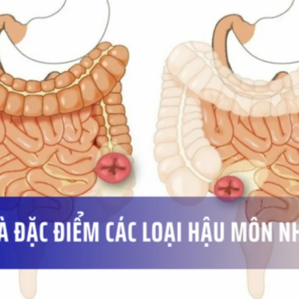 Tìm hiểu về các phẫu thuật hậu môn nhân tạo: vị trí và đặc điểm
