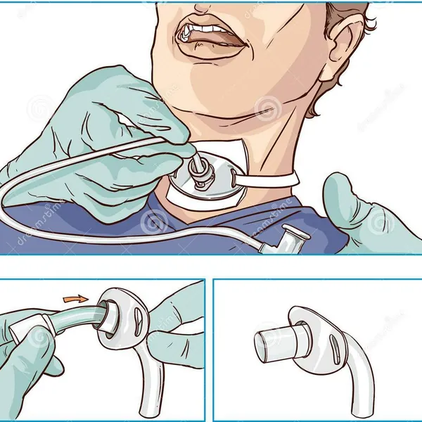 Thay ống mở khí quản phần 2