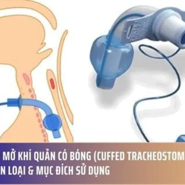 Ống Mở Khí Quản Có Bóng (Cuffed Tracheostomy Tube): Phân Loại & Mục Đích Sử Dụng